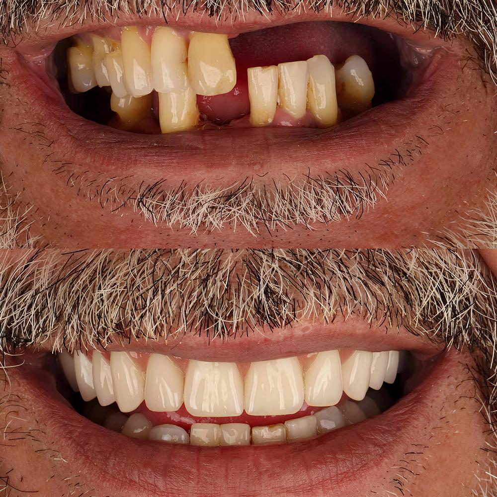 Arriba, dientes desgastados con huecos; abajo, la misma boca con una arcada superior completa.