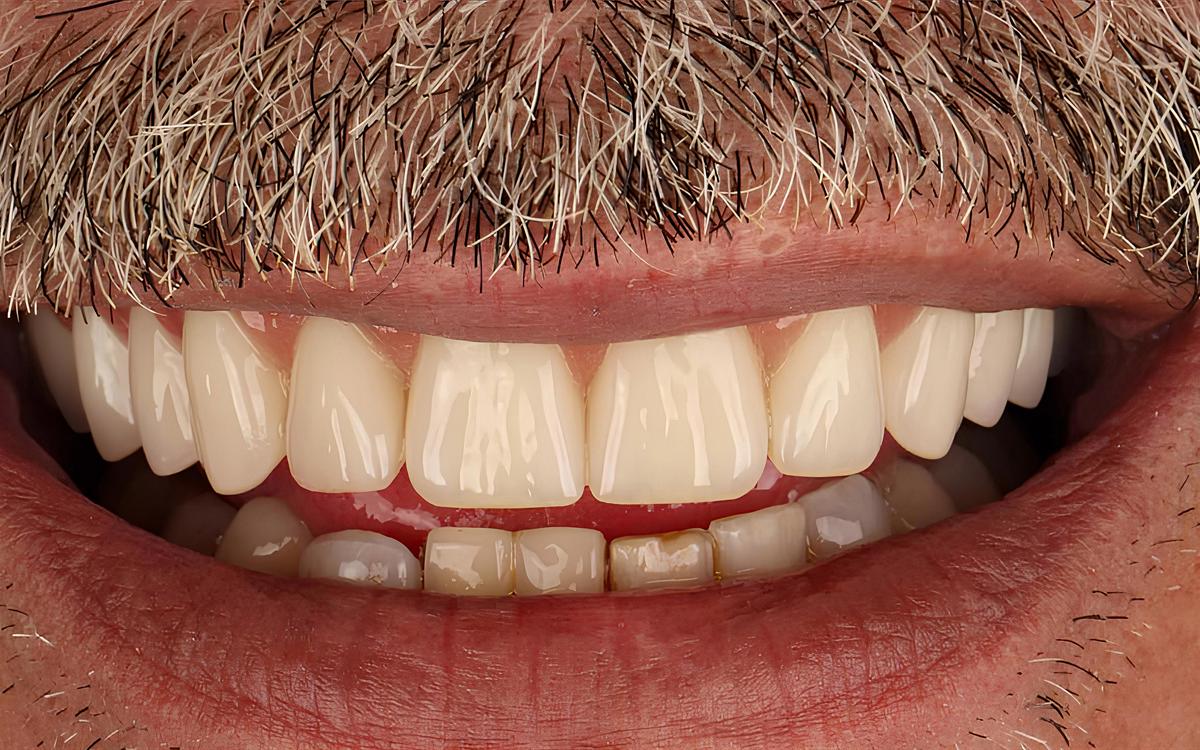 Sonrisa de un hombre con bigote canoso con una arcada superior completa recién colocada.