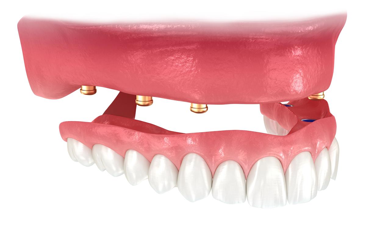 Ilustración en 3D de una sobredentadura superior que se encaja sobre cuatro implantes.